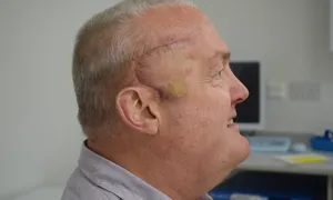 Khối u não co lại một nửa nhờ liệu pháp mới